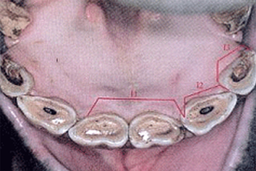 아래턱 절치의 모습. 겸치들 (11)에서만 치인이 보인다. 중간치들에서는 치와 (cup)가 완전히 맞닿아 있다. 우치들에는 아직 교합이 되지 않은 치와가 뚜렷하게 있다.