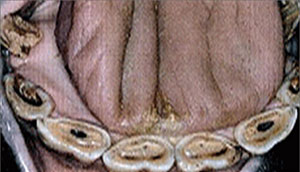 치성은 상아질로 덮인 치수를 말한다 (앞쪽의 어두운 부분).치인은 치와의 나머지 부분을 말한다 (뒤쪽의 어두운 부분)