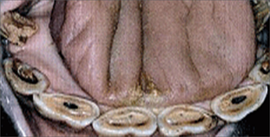 치성은 상아질로 덮인 치수를 말한다 (앞쪽의 어두운 부분).치인은 치와의 나머지 부분을 말한다 (뒤쪽의 어두운 부분)